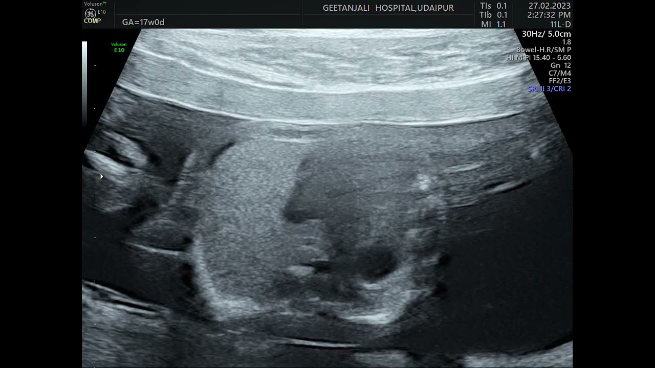 Pulmonary aplasia / congenital lung agenesis. #fetalmedicine #fetalultrasound #GeetanjaliHospital