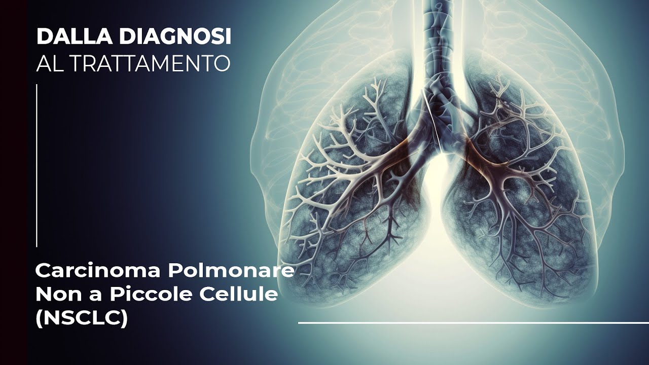 Quali sono le Opzioni: Cancro al Polmone e Cancro al Polmone Non a Piccole Cellule