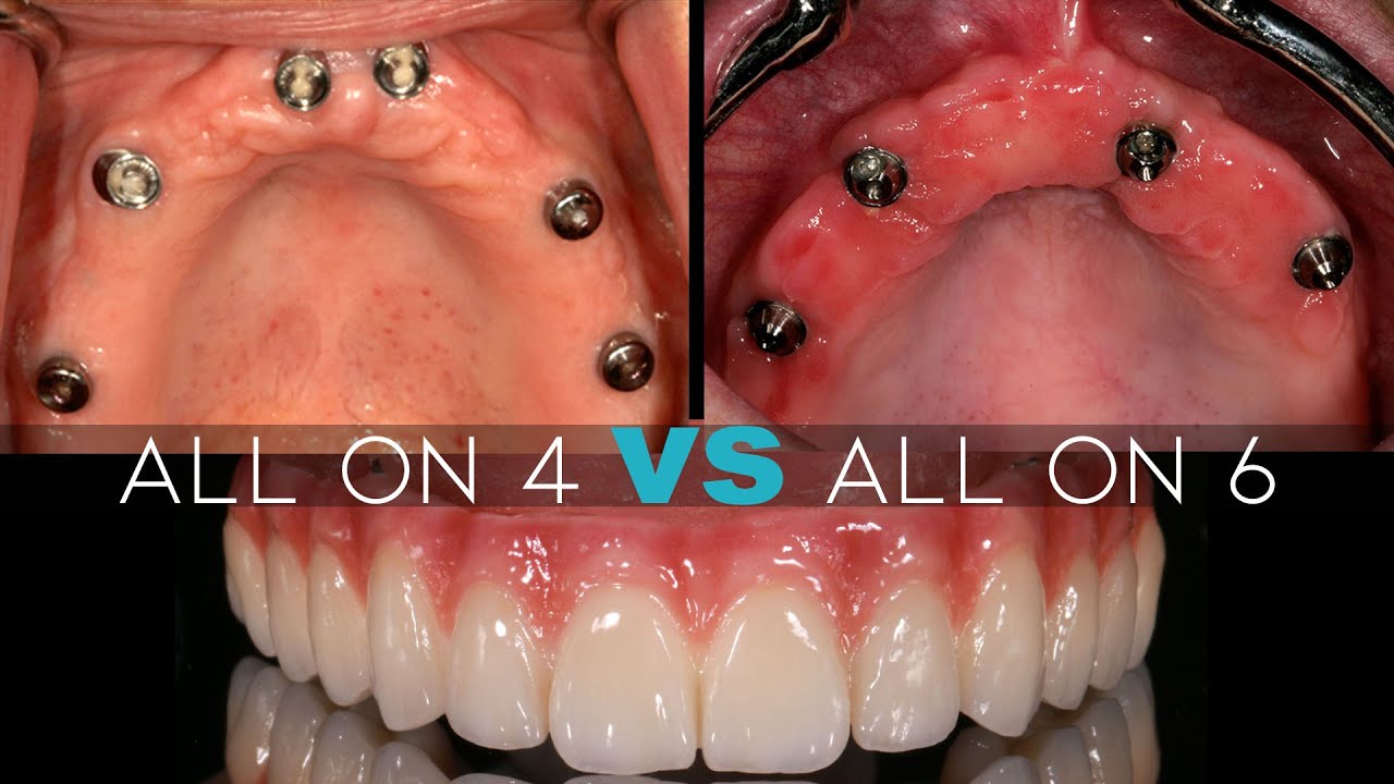 Should I Get 4 or 6 Dental Implants?