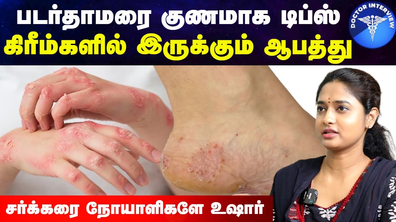 படர்தாமரை முற்றிலும் குணமாக | Padarthamarai sari seivathu eppadi | Fungal Infection|Doctor Interview