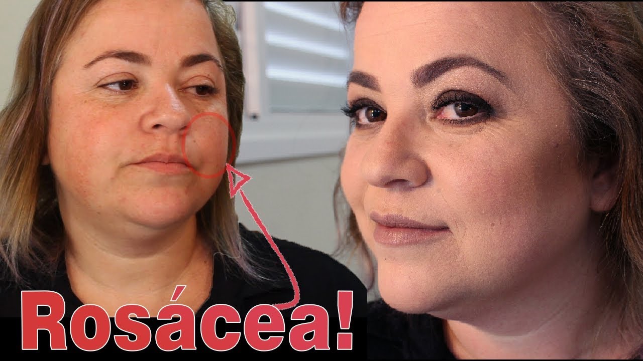 COMO MAQUIAR UMA PELE COM ROSÁCEA?