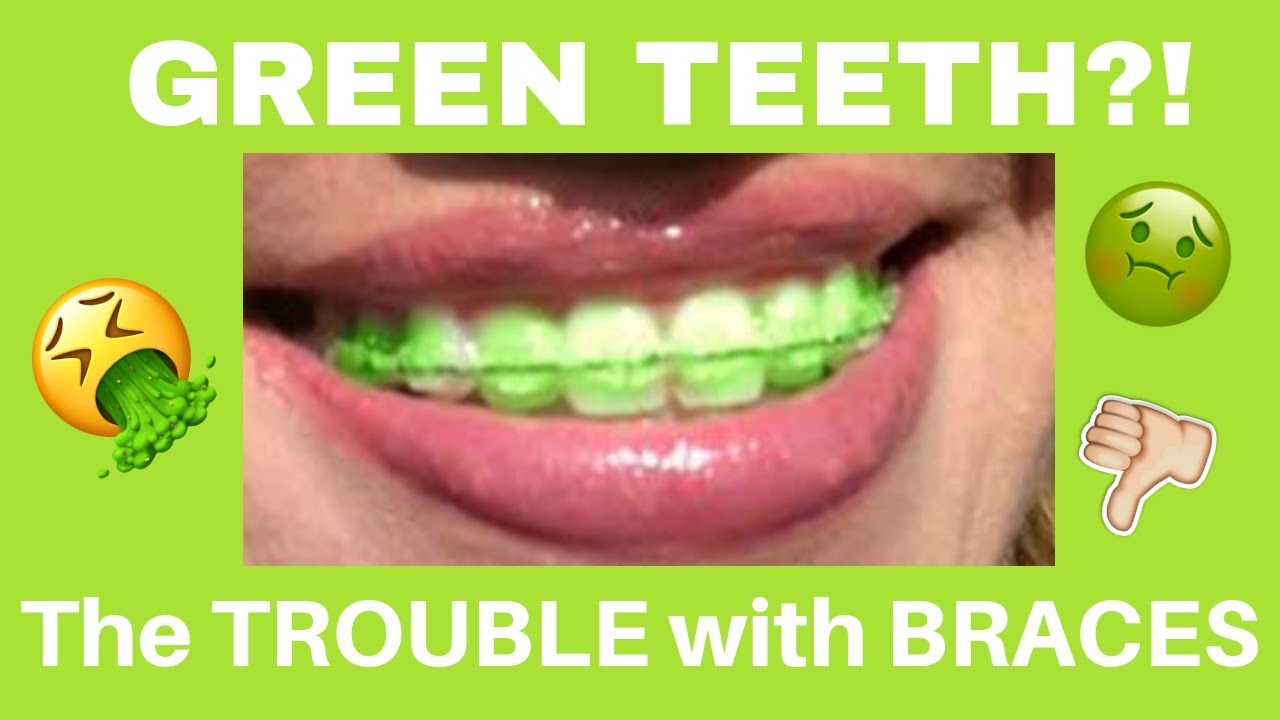 🔴LIVE: GREEN TEETH?! 🤮🤢🤮 BRACES PROBLEMS...