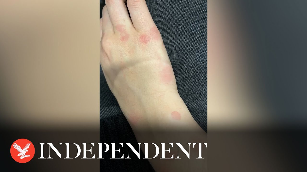 Travel vlogger documents finding bed bugs in Paris AirBnB