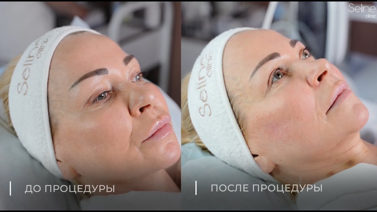 Монополярный RF-лифтинг на аппарате Volnewmer | Врач-косметолог Кислова Надежда Михайловна
