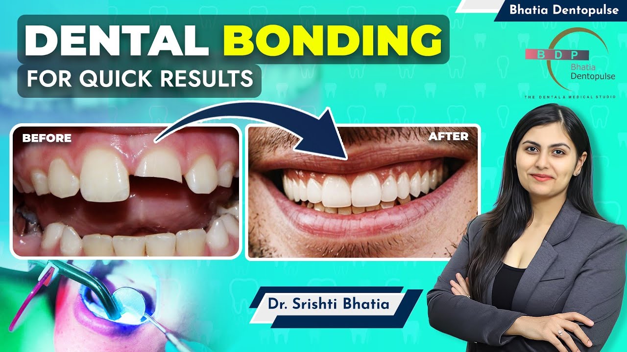 DENTAL BONDING for Broken Tooth, Teeth Gap: Dr. Srishti Bhatia #composite #veneers #smilemakeover