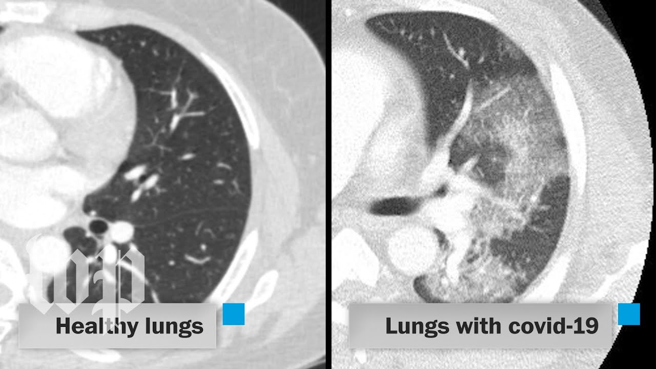 How covid-19 attacks the lungs