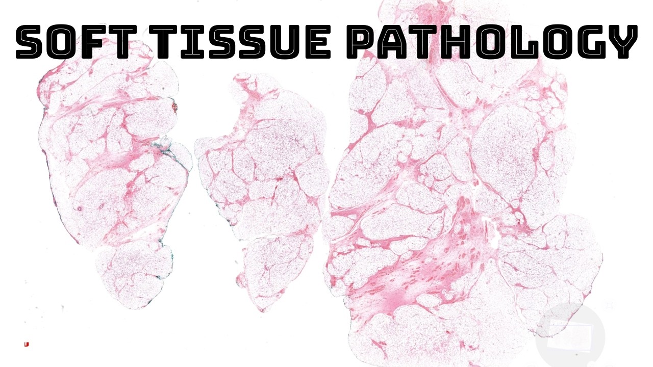 Soft Tissue Pathology Case Discussion for FedPatMex 2023: lipoblastoma, Kaposi, angiosarcoma, & more