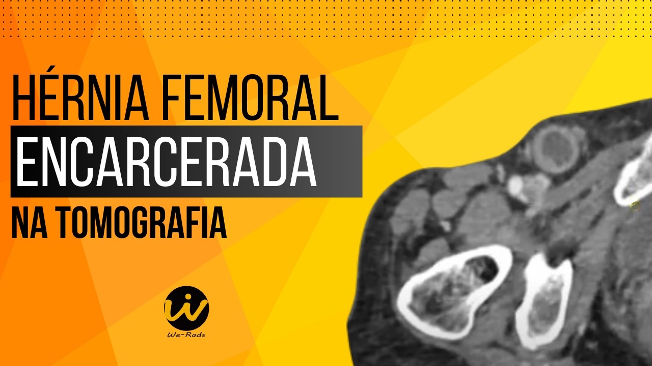 Hérnia Femoral Encarcerada