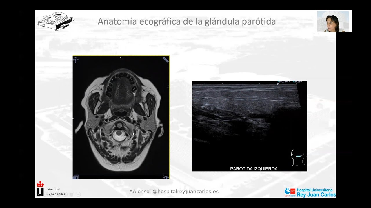 Ecografía de las glandulas salivares (15mn)