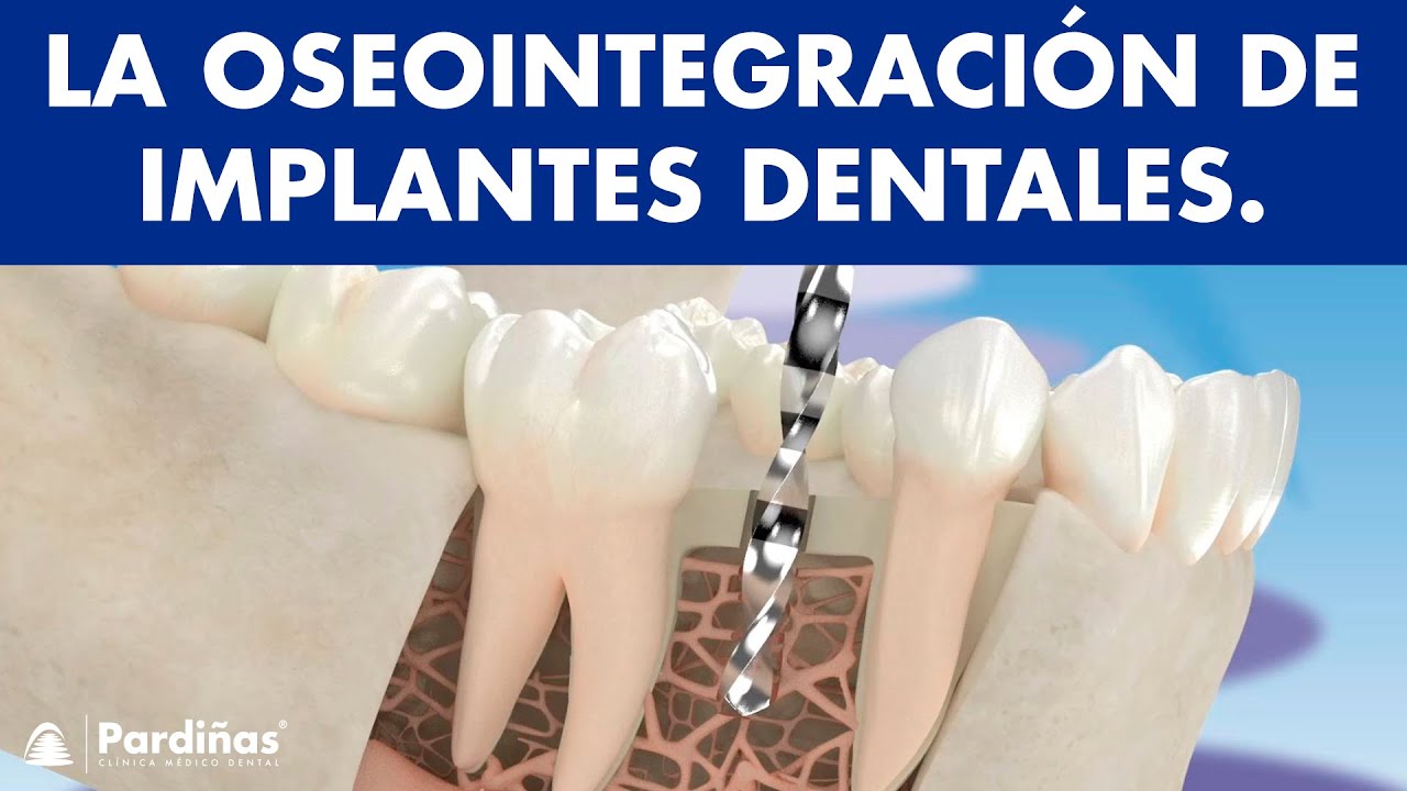 ASOMBROSO PROCESO de oseointegración de IMPLANTES DENTALES - ¿En qué consiste? ©