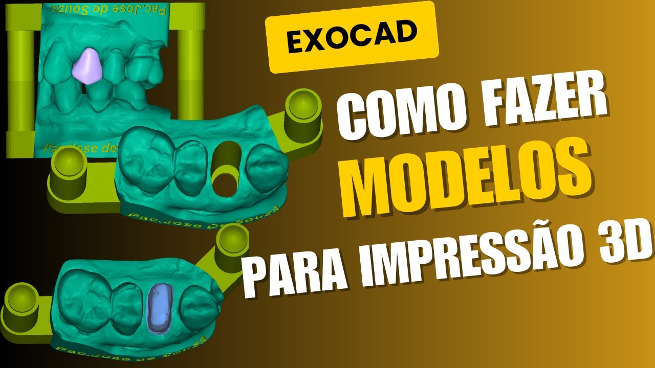 EXOCAD: Troquel Alveolar vs Troquel Destacado no Exocad: Qual usar na Impressão 3D?