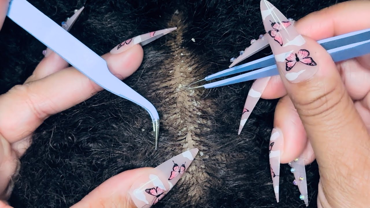 ASMR: Dandruff And Hair Picking With Tweezers On AFRO Hair~Scalp Scratching~Tingles!!!~No Talking