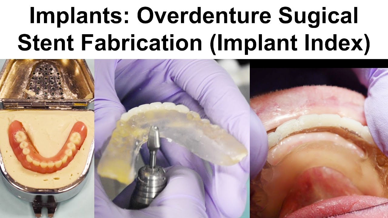 1. Implants: Overdenture Surgical Stent Fabrication (Implant Index)