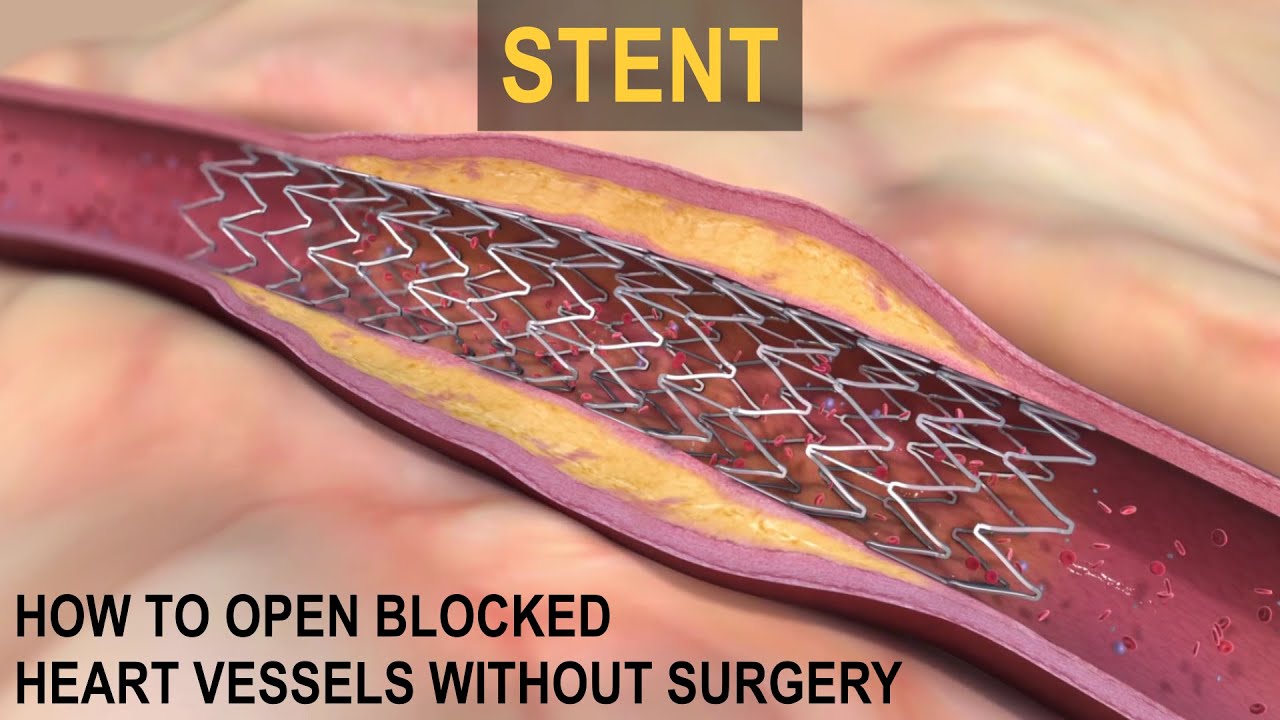 What is a STENT?