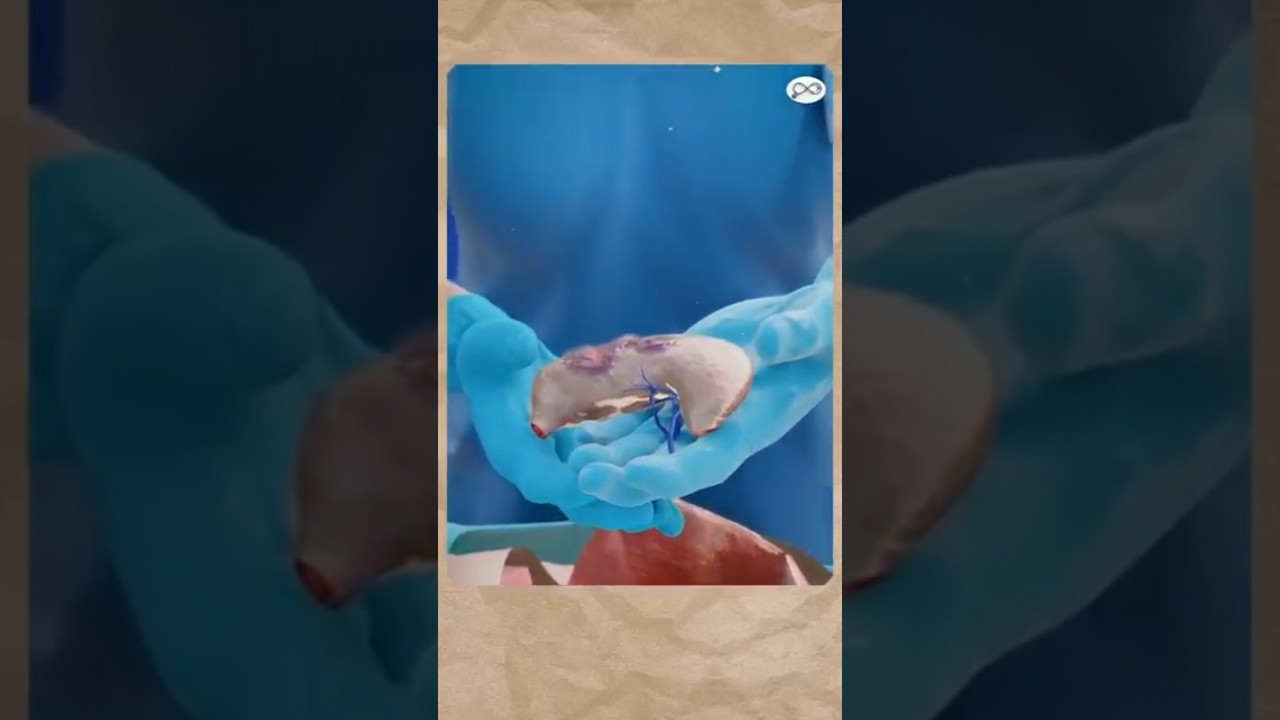 هل يمكن للانسان العيش بدون معدة؟ و ما الحالات التى يتم فيها استئصال المعدة #explore  #viralvideo