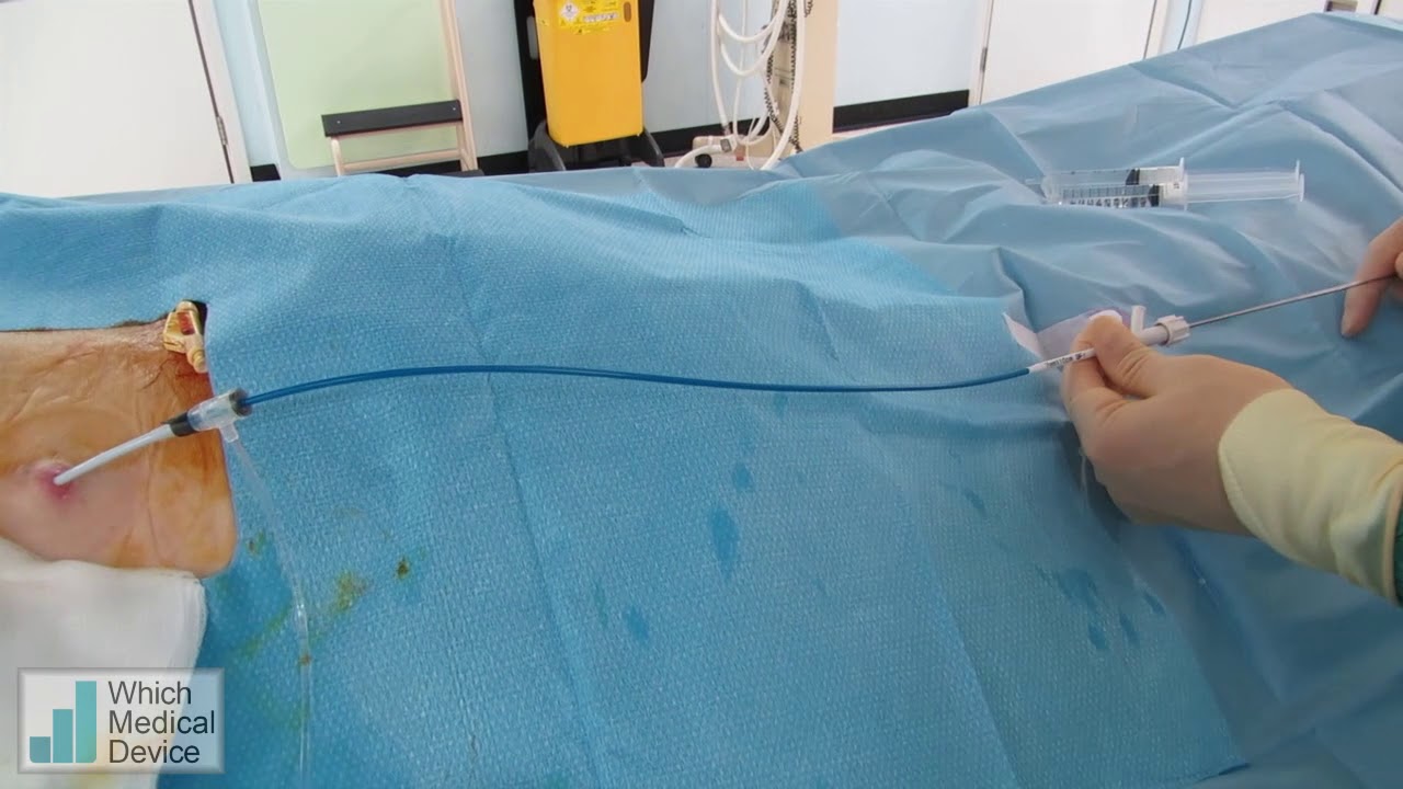 Uventa covered ureteric stent placement
