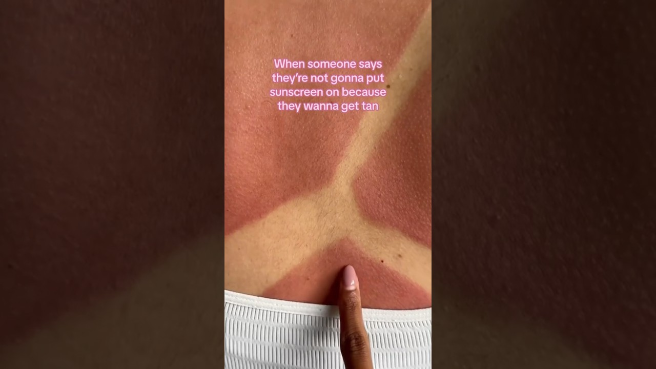 POV: ME REMEMBERING TO PUT ON SUNSCREEN☀️#cocoandeve #sunscreen #spf #sunburn #tanning #summer