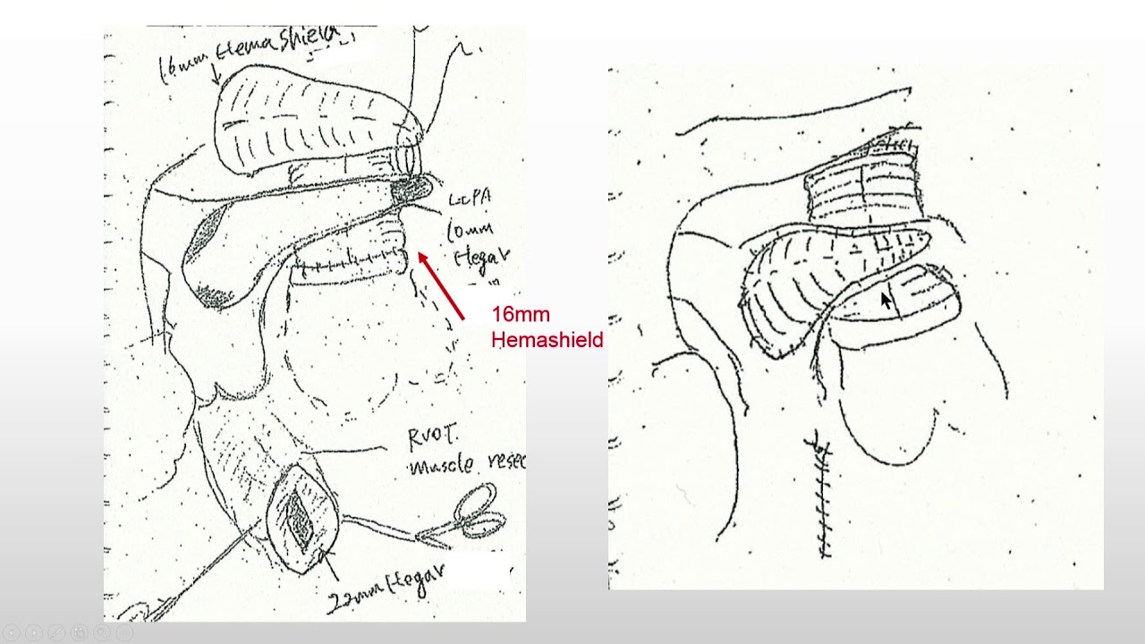 A case of difficult treatment of Taussig-Bing anomaly and coarctation of aorta