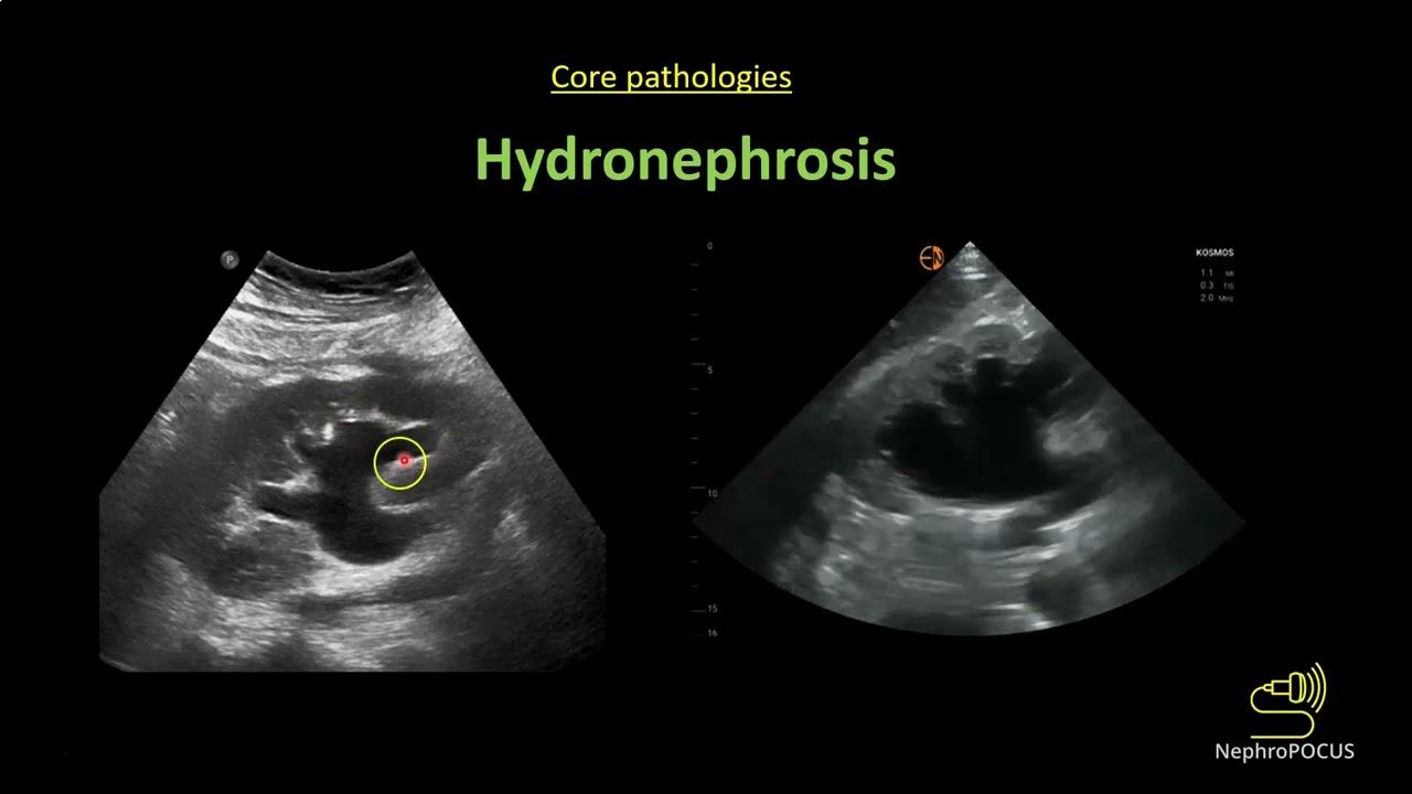 Point-of-care ultrasound of the Kidney: an overview I Dr. Koratala @NephroP