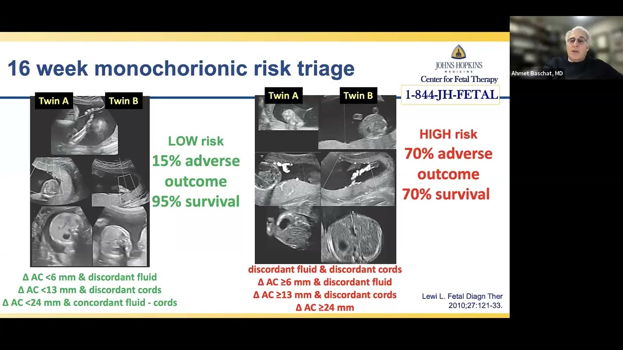 Management Guidance for Monochorionic Twin Pregnancies Webinar