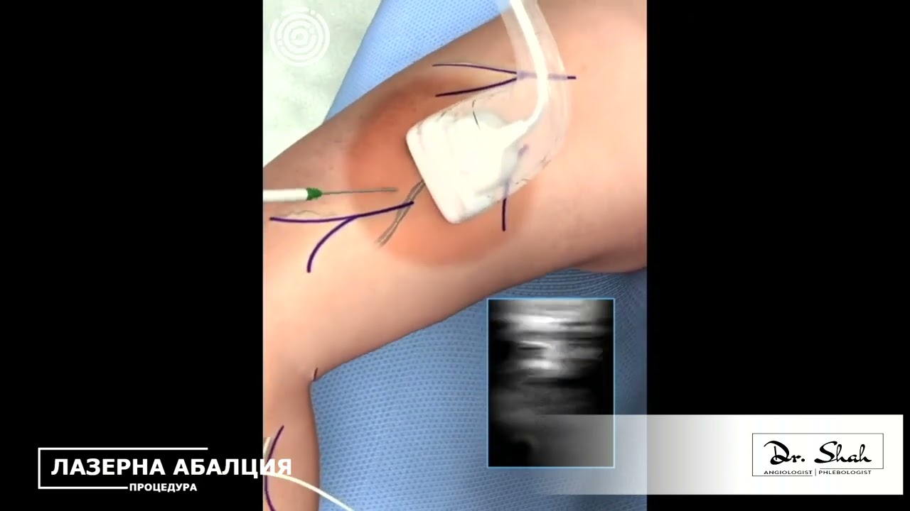 lazer ablation