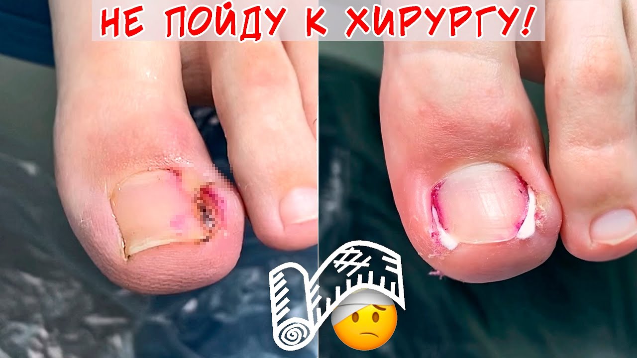 Вросший ноготь и гной под ногтем / Горький опыт обращения к хирургу