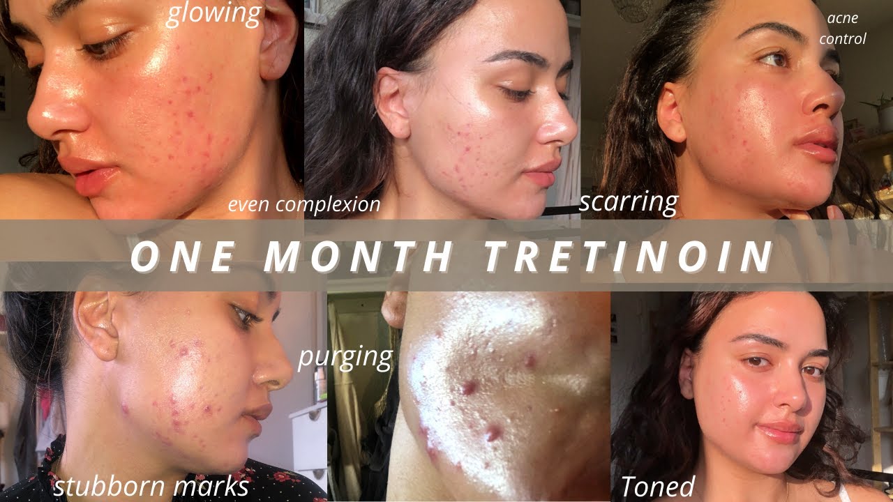 WHY I CANCELLED MY HARLEY STREET DERMATOLOGY APPOINTMENT | TRETINOIN 1 MONTH UPDATE | #Dermatica