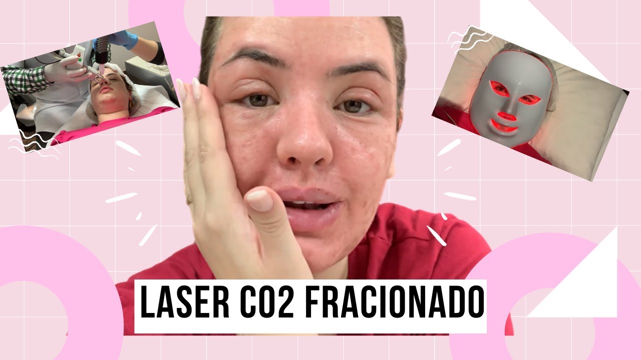 Laser de CO2 Fracionado - Vale a Pena para Cicatrizes de Acne?