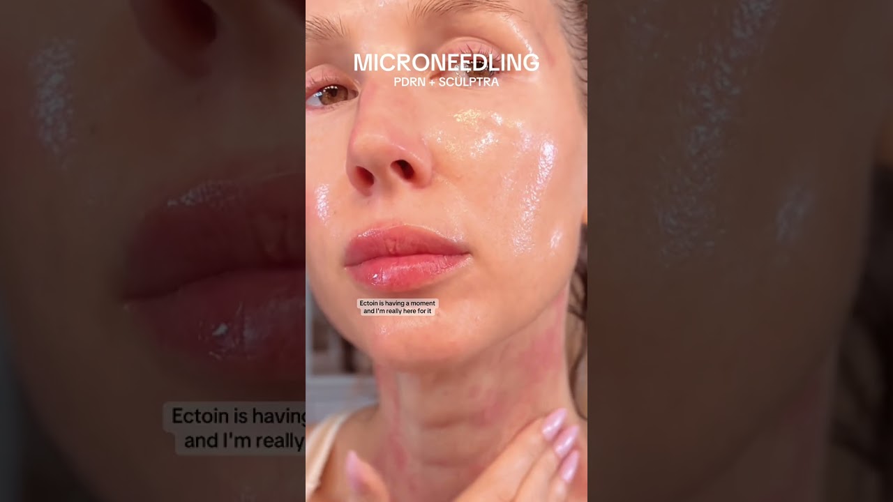 Microneedling: PDRN + Sculptra