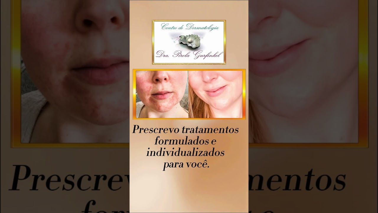 COCEIRA, DESCAMAÇÃO, PELE RACHADA!!    