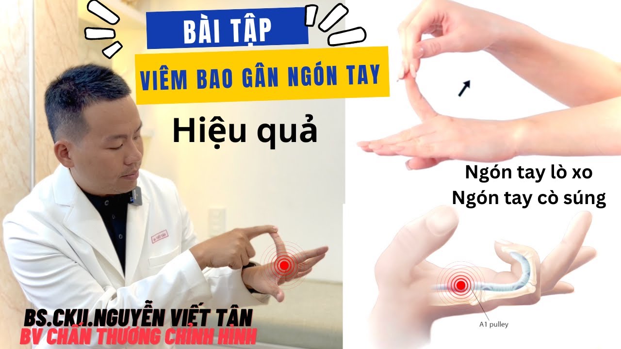 Bài tập trị đau ngón tay viêm bao gân ngón tay - ngón tay lò xo - ngón tay cò súng hiệu quả