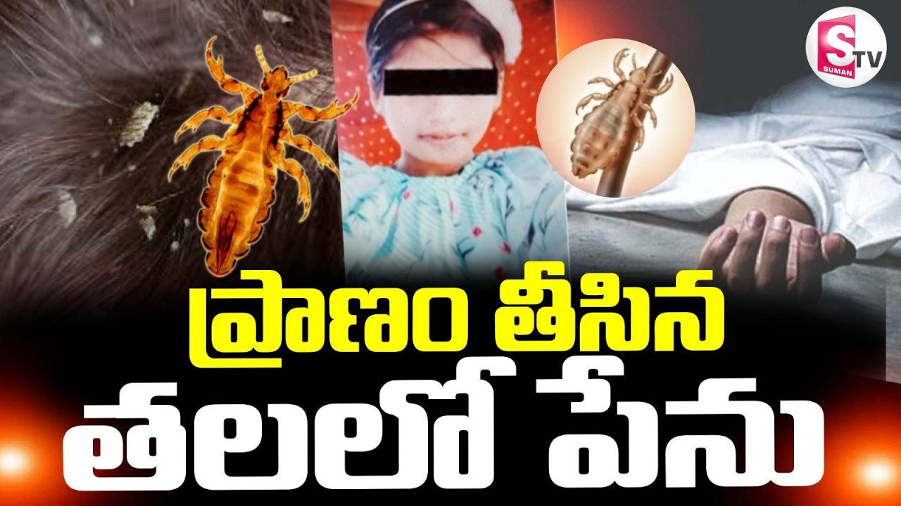 చిన్నారి ప్రా_ణం తీసిన తలలో పేలు! | Head Lice Infestation | Latest News | SumanTV Vali