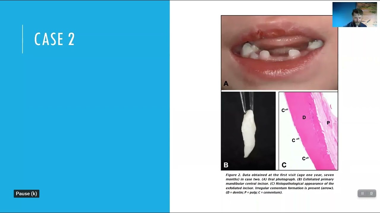 Hypophosphatasia and the Dentist - Charlie Clark, DMD