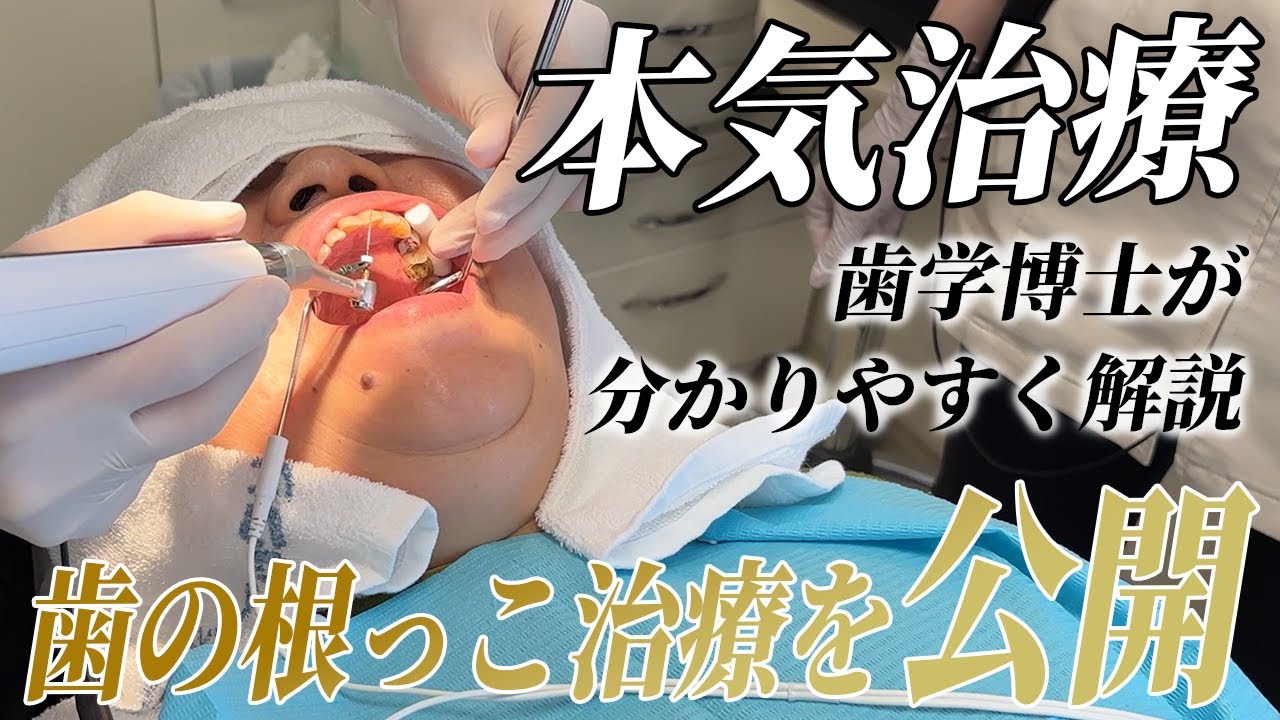 【本気治療】歯学博士ひだっちが歯の根っこの治療をお見せします！
