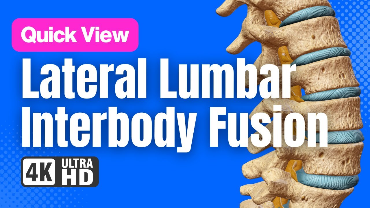 Lateral Lumbar Interbody Fusion (LLIF) - See How It Works - 3D Animation