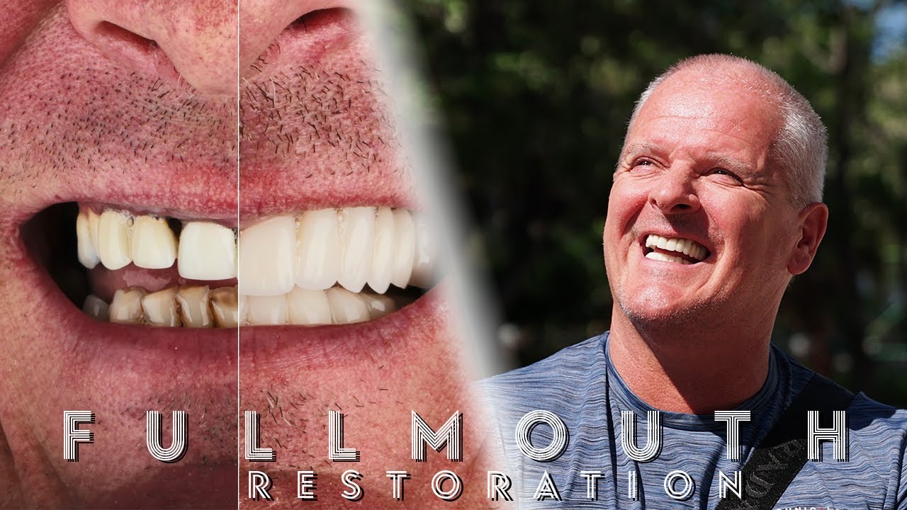 Full Mouth Restoration / Testimonial
