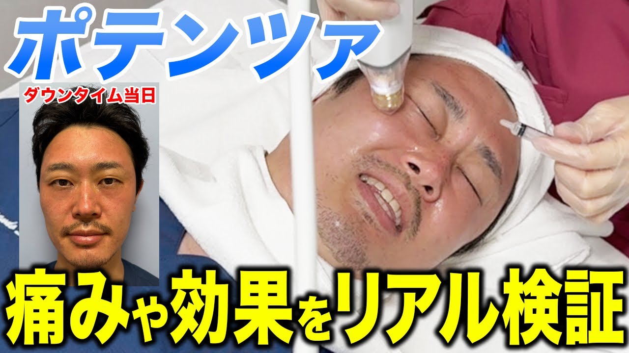 【ポテンツァ】実際に受けてみたらめちゃくちゃ痛いけど効果ヤバかった