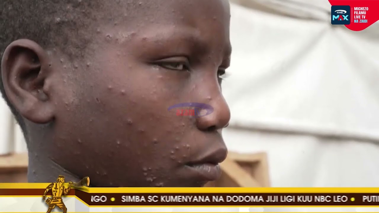 Zijue dalili za ugonjwa wa Mpox na namna unavyoweza kujiepusha nao