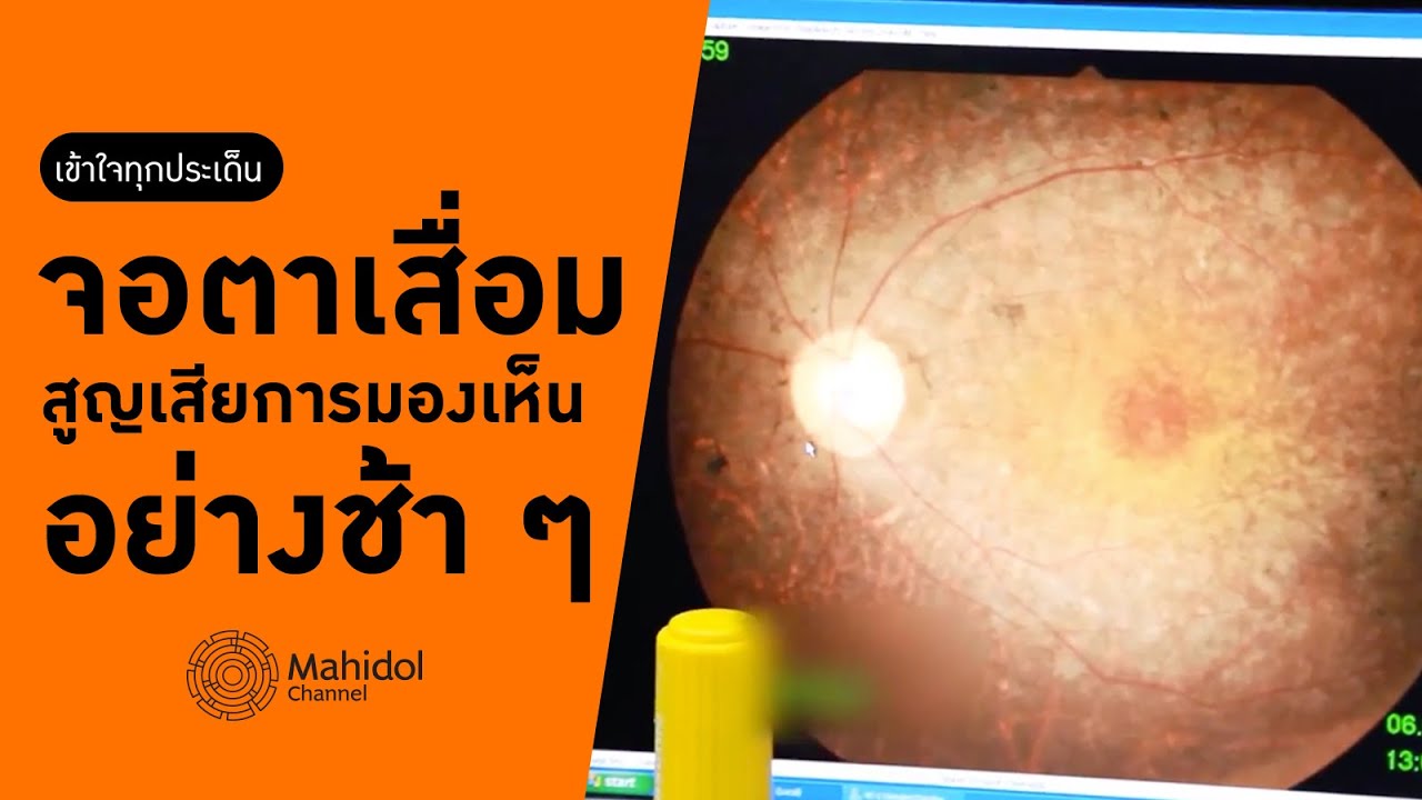 โรคจอประสาทตาเสื่อม RP เข้าใจภาวะสูญเสียการมองเห็นอย่างช้า ๆ [หาหมอ by Mahidol Channel]