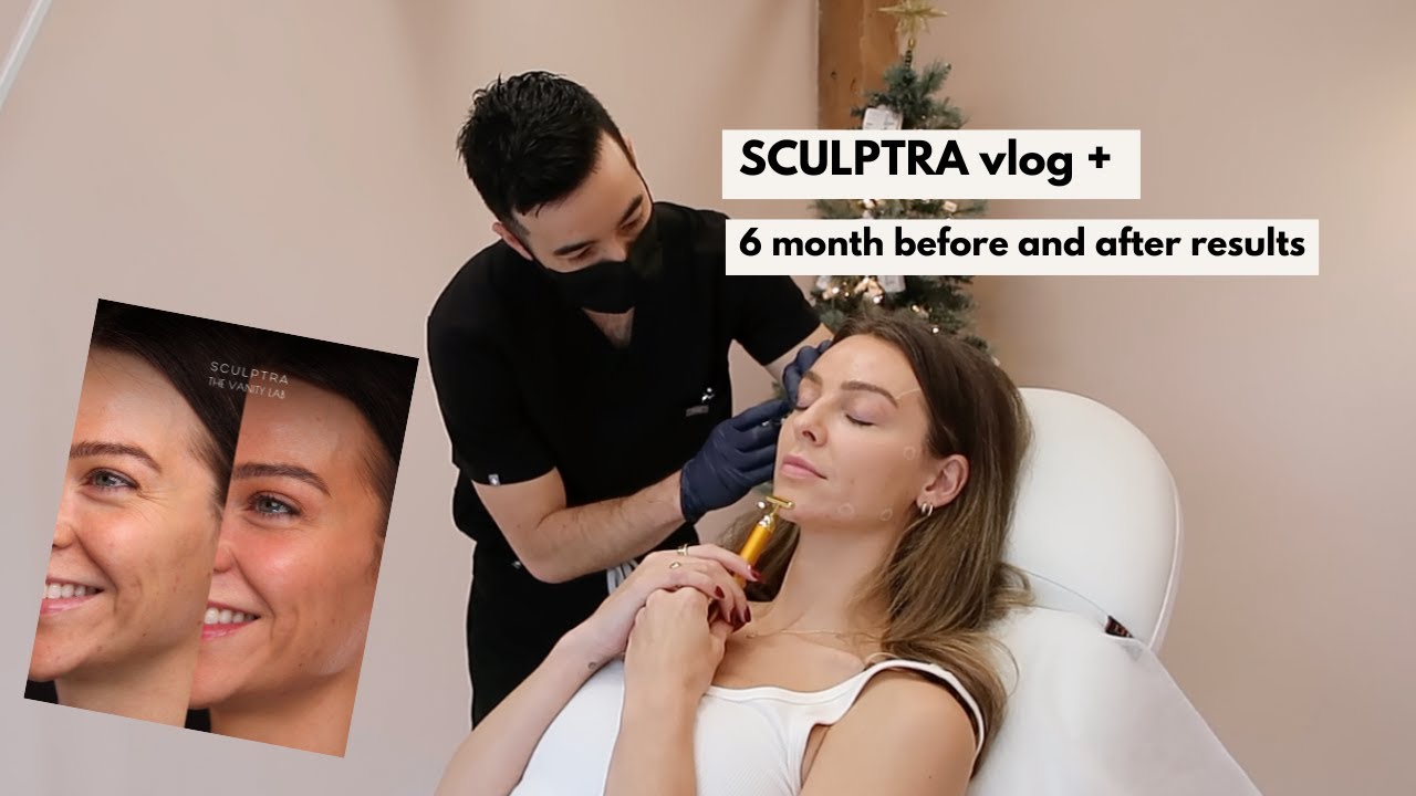 Sculptra (face) before & after + my experience | VLOG