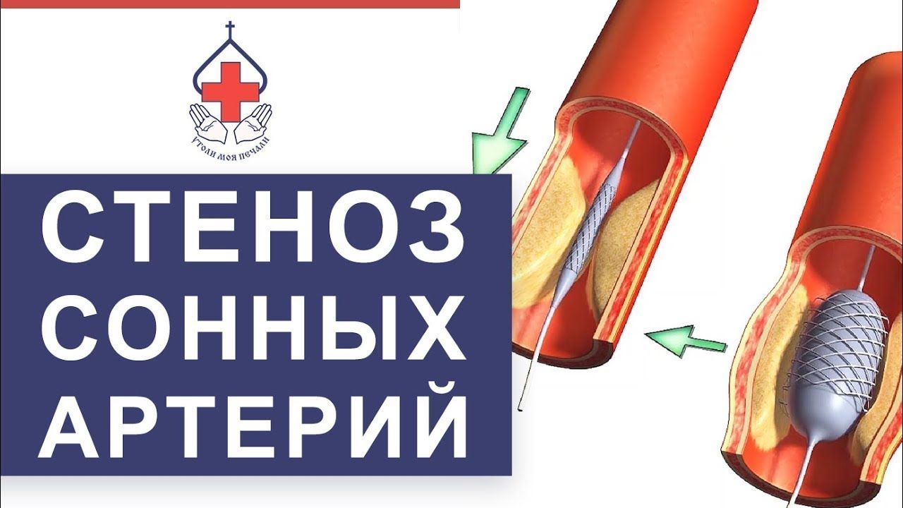 💤 Уникальный метод лечения атеросклероза сонных артерий. Лечение атеросклероза сонных артерий. 12+