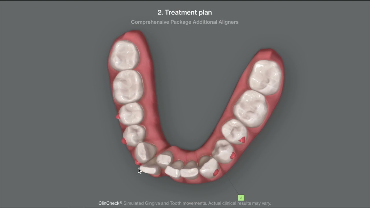 Treating moderate lower crowding with Invisalign&trade;