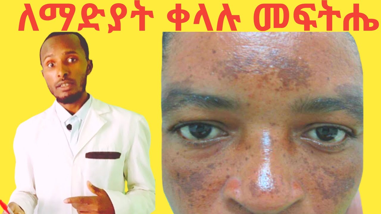 100% ዉጤታማ ‼ ማድያት በቀላሉ ለማጥፋት ተፈጥሮአዊ መፍትሄዎች Melasma causes and easy home treatments