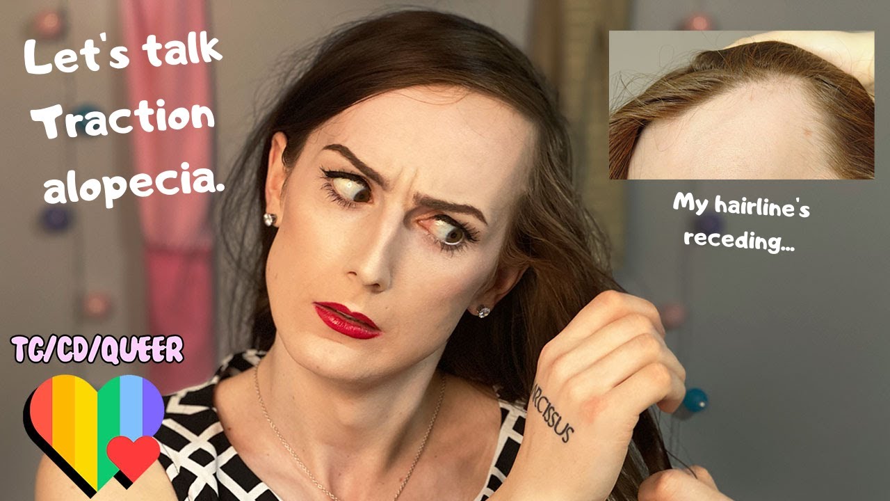 Dealing With Longer Hair and a Receding Hairline (Traction alopecia) | DIMITRIA SPARROW