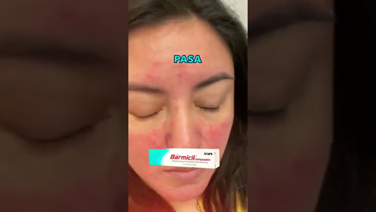 Da&ntilde;o cr&oacute;nico por la cortisona y efectos secundarios ustedes que opinan ? Dermat&oacute;logo militar CDMX