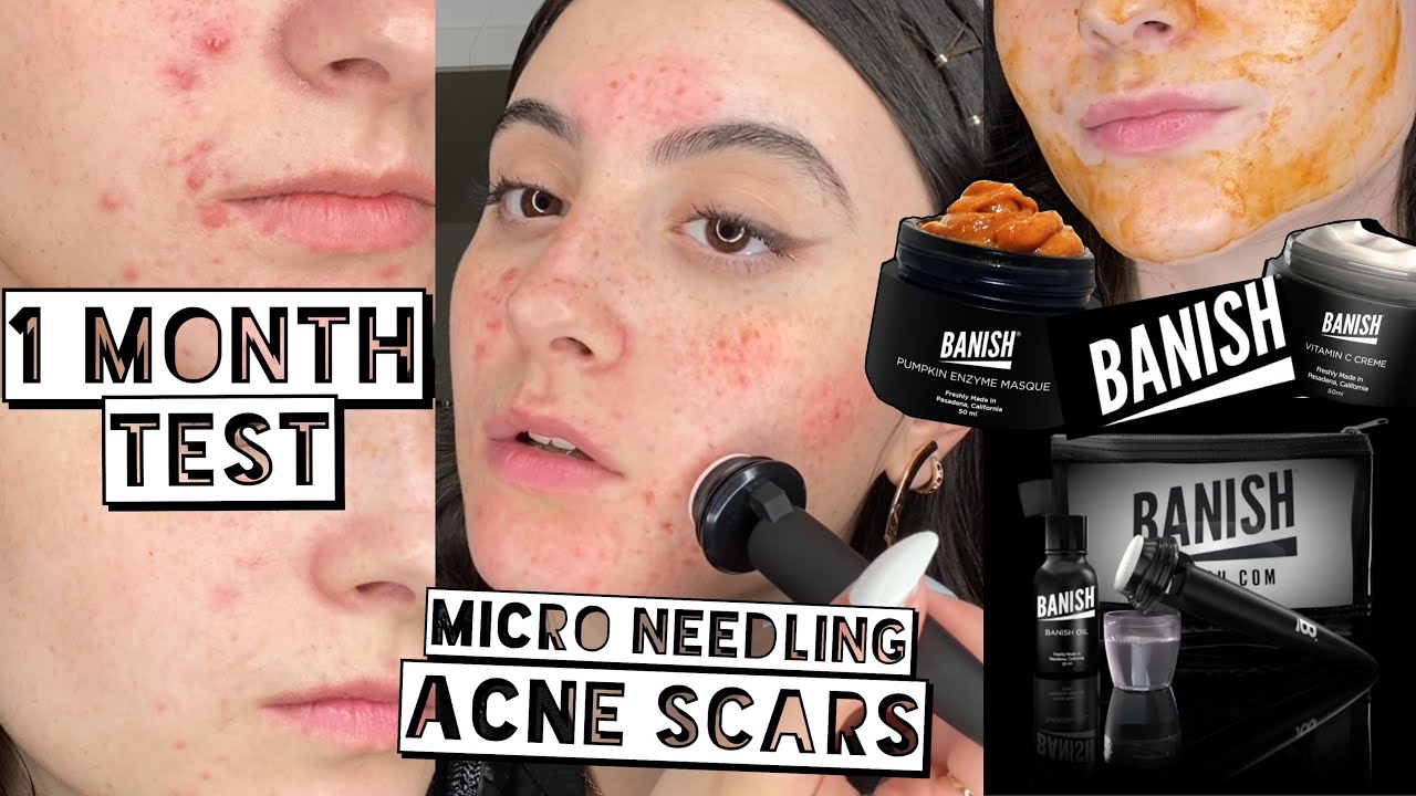 I TRIED BANISH FOR 1 MONTH ON ACNE SCARS | How To Fade Acne Scars | Banish Collection Review
