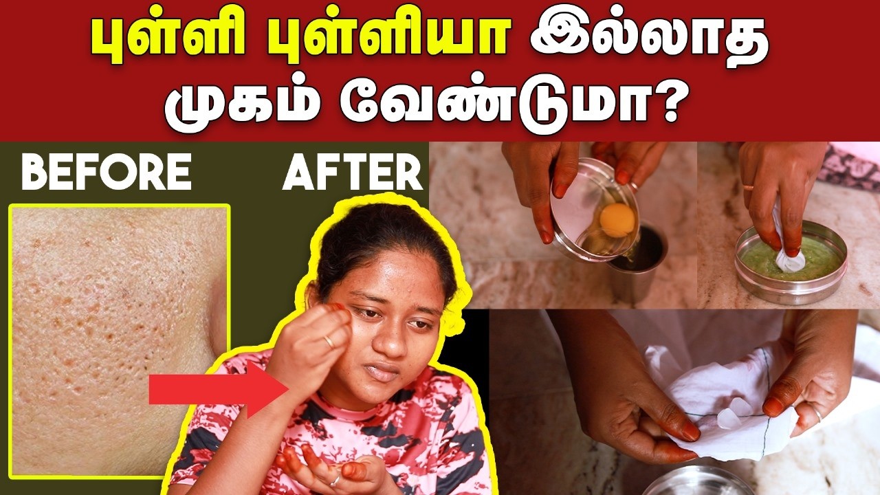 Open Pores: இனி முகத்துல குழி குழியா இருக்குனு Feel பண்ணாதீங்க | home remedies | Creams to use pore