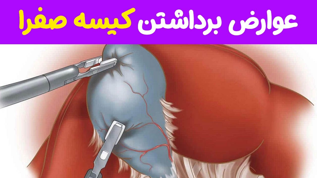 عوارض برداشتن آپاندیس و کیسه صفرا - دکتر شأنی