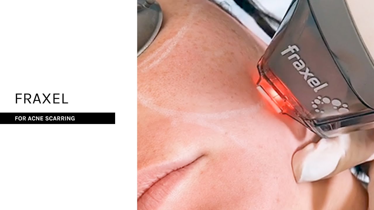 Live Fraxel Laser Treatment | For Acne Scarring