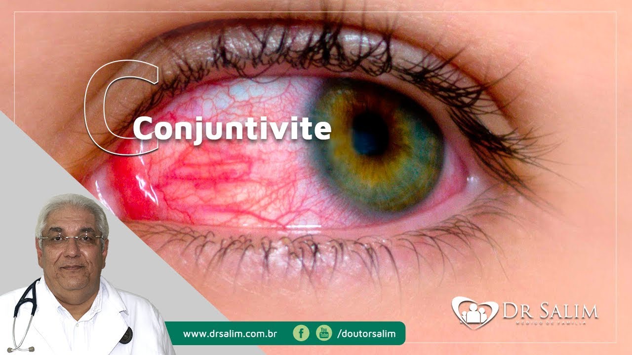 Conjuntivite | Dr. Salim CRM 43.163
